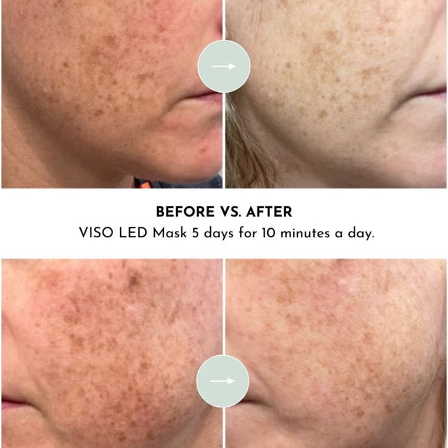 Lumara | VISO | Red Light Therapy Mask