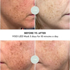 Lumara | VISO | Red Light Therapy Mask