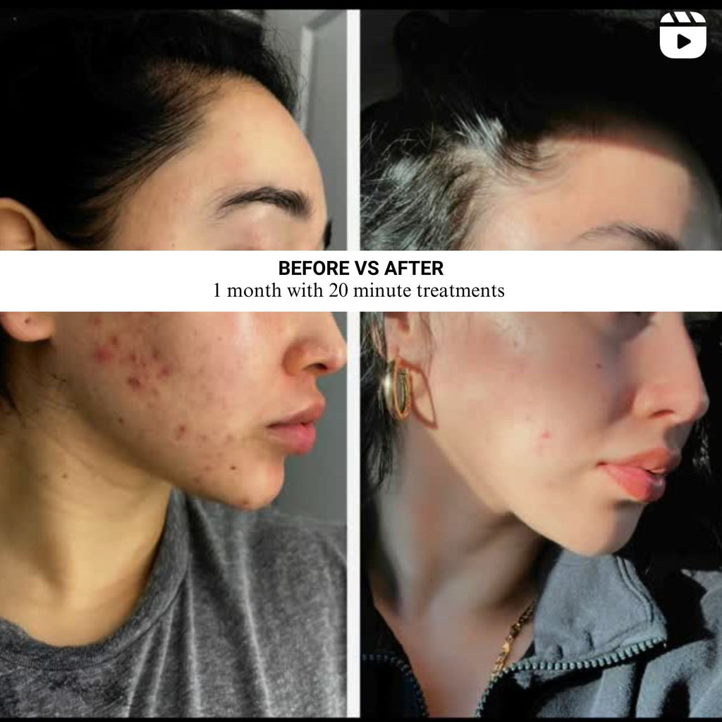Lumara | VISO | Red Light Therapy Mask